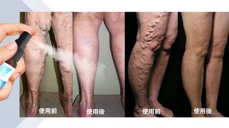 静脉喷雾JP_34.jpg